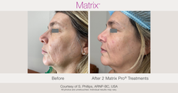 BA-Matrix-SPhilips-2Tx-006