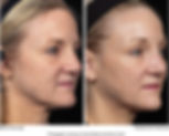 Before-and-after-pictures-of-a-patient-treated-with-Thermage-to-the-full-face.jpg