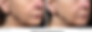 Before-and-after-pictures-of-a-patient-treated-with-Thermage-to-the-lower-face.jpg.png