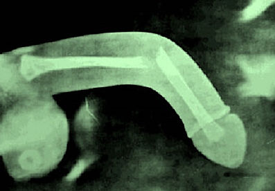 أكثر الأسباب شيوعًا لكسر القضيب