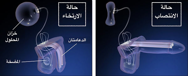 زراعة دعامة القضيب الدعامة ذات المضخة والخزان