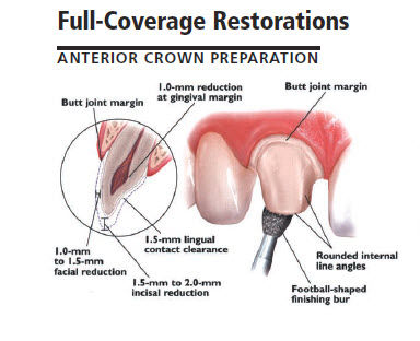 anterior lithium disilicate IPS emax prep guide