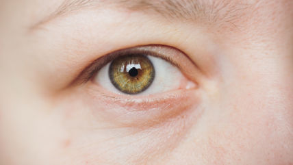 Why PRP is my first choice for under eye treatment