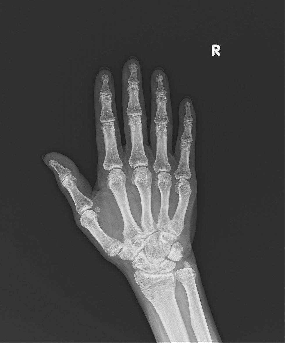 手のレントゲン写真