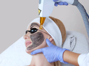 Is Laser Carbon Peel Effective for Acne Scars?