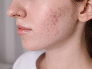 How to find the best dermatologist  for acne scars?