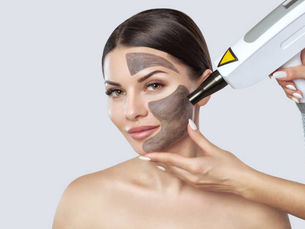 How Does Laser Carbon Peeling Improve Skin?