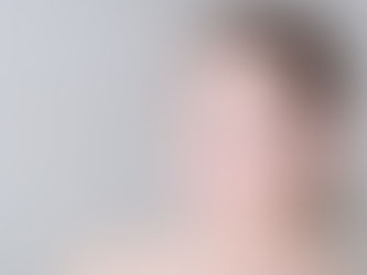 Is Morpheus 8 Treatment Worth It for Acne Scars?