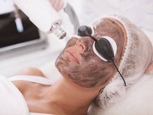 Can Laser Carbon Peeling Reduce Acne Marks?