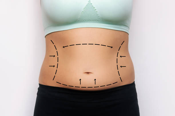 Can Mini Tummy Tuck Remove Loose Lower Belly Skin?