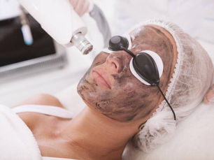 Can Laser Carbon Peeling Reduce Acne Scars?