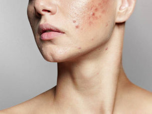 Is Acne Treatment Effective for Stubborn Breakouts?