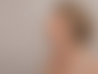 Can Neck Lift Surgery Remove Double Chin Fast?