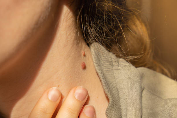 How Does Mole Removal Target Unwanted Skin Moles?