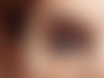 Is Eyelid Surgery Right for Droopy Eyelids?