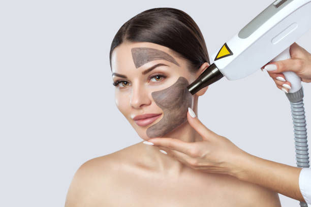 Can Laser Carbon Peeling Reduce Acne Scars?
