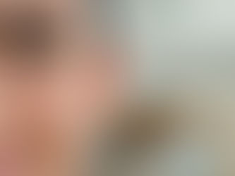 How Does Eyelid Surgery Improve Persistent Puffy Eyes?