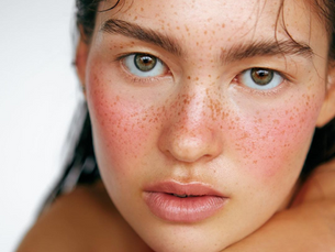 How Does Melasma Treatment Fade Dark Patches?