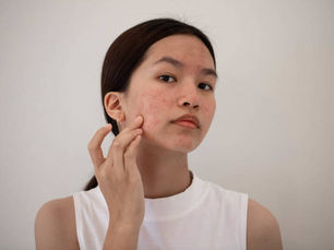 Can Laser Acne Scar Treatment Boost Confidence?