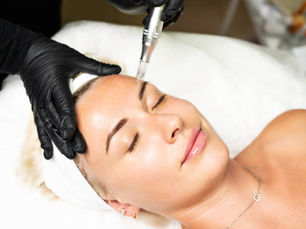 Can Microneedling Help Reduce Acne Scars Fast?