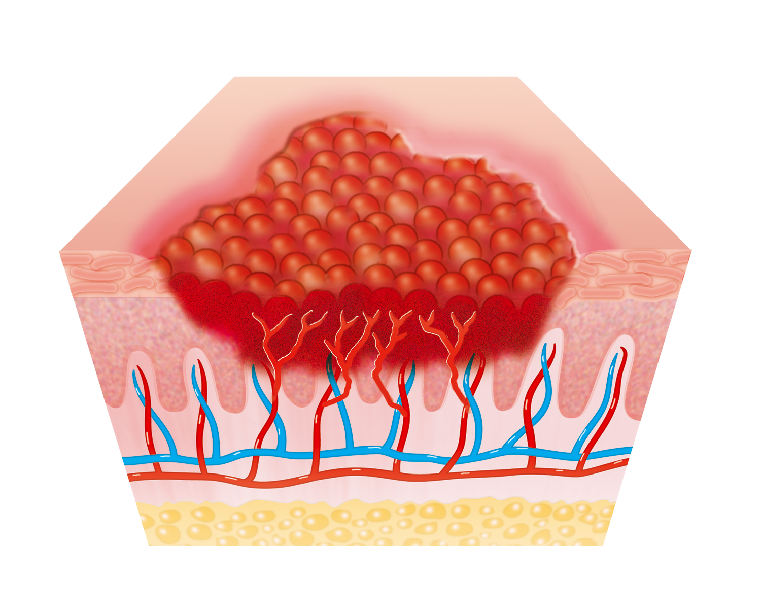 wound types trigocare