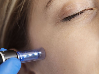microneedling 2.jpg