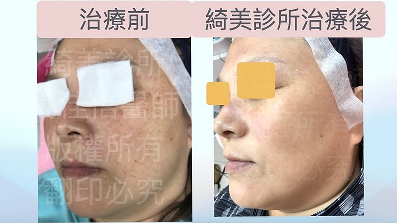 除斑,雷射,黑斑,