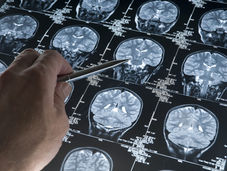Before You Forget: The Science Behind Catching Alzheimer’s Early