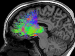 Brain Activity of A Teenager 