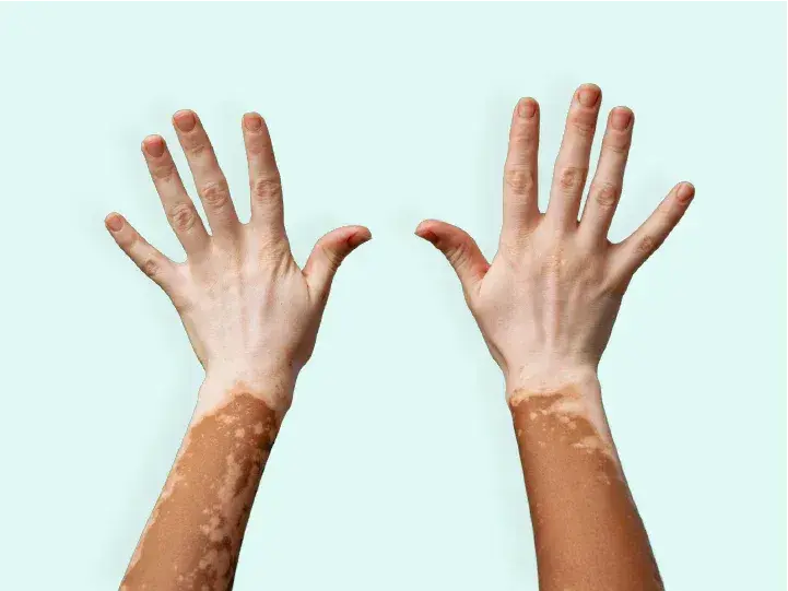 Vitiligo: A Journey Through Skin, Science, and Society