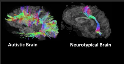 What Does a Neurodivergent Brain Really Look Like? Let’s Talk Neural Pathways