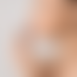 STUDY FULL: Lip Lift (Study 26-12)