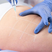 Mesoterapia_ di che si tratta, quando effettuare il trattamento, benefici e controindicazi