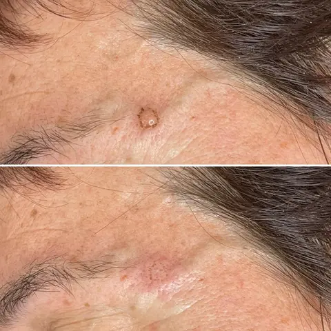 Rimozione Fibroma plexer