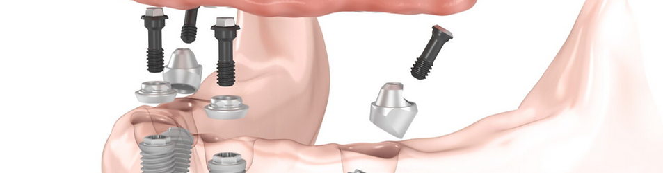 La perdita anche di un solo dente comporta modificazioni a carico di tutto l’apparato masticatorio, che si fanno sempre più evidenti e difficilmente risolvibili quanto più passa il tempo.