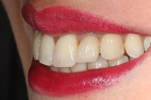 Finalizzazione protesica del caso. Visione laterale