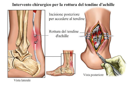 Metodica riservata a casi cronici e a recidive