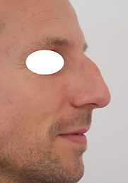 Naso grosso, naso spesso