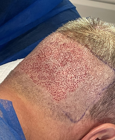 BLOG-Do-hair-transplants-cause-scarring-FUE-donor-area-extraction-1-2048x1536.jpg