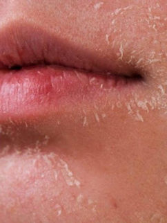 Khô da quanh miệng - Nguyên nhân và cách điều trị