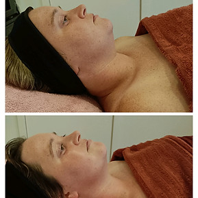 voor en na hifu deluxe lift.jpg