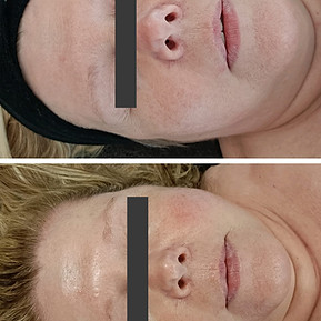 purabeau voor en na carboxy_edited.jpg