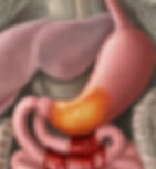 Peptic Ulcer Disease (Gastric or duodenal ulcers)