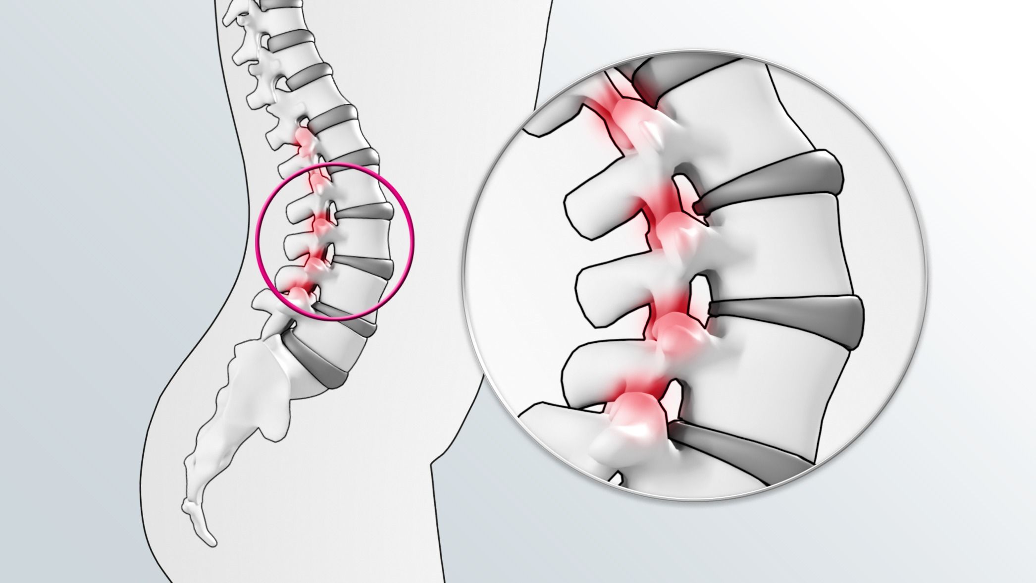 Lumbar-facet-joints.webp