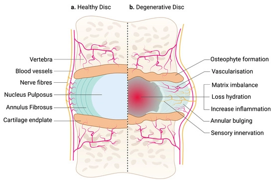 Spinal-disc-anatomy.webp