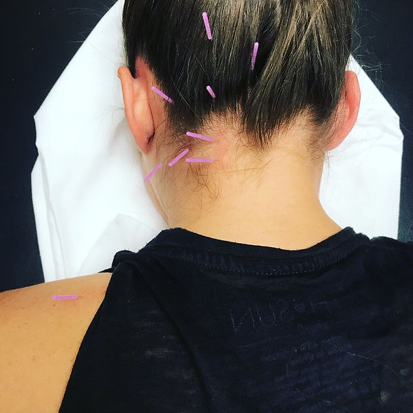 Dry Needling for headache performed in the chiropractic office