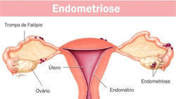 Endometriose
