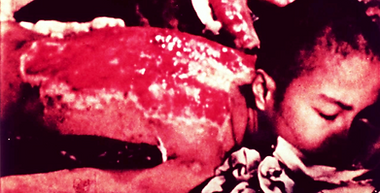 hiroshima burn victim