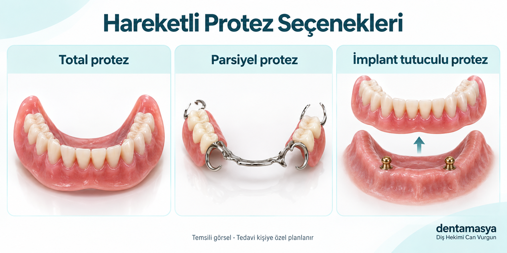 Total, parsiyel ve implant tutuculu hareketli protez seçeneklerinin Dentamasya filigranlı temsili görseli