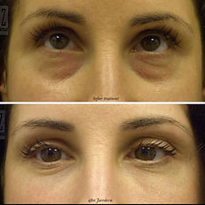 Eyebag treatment